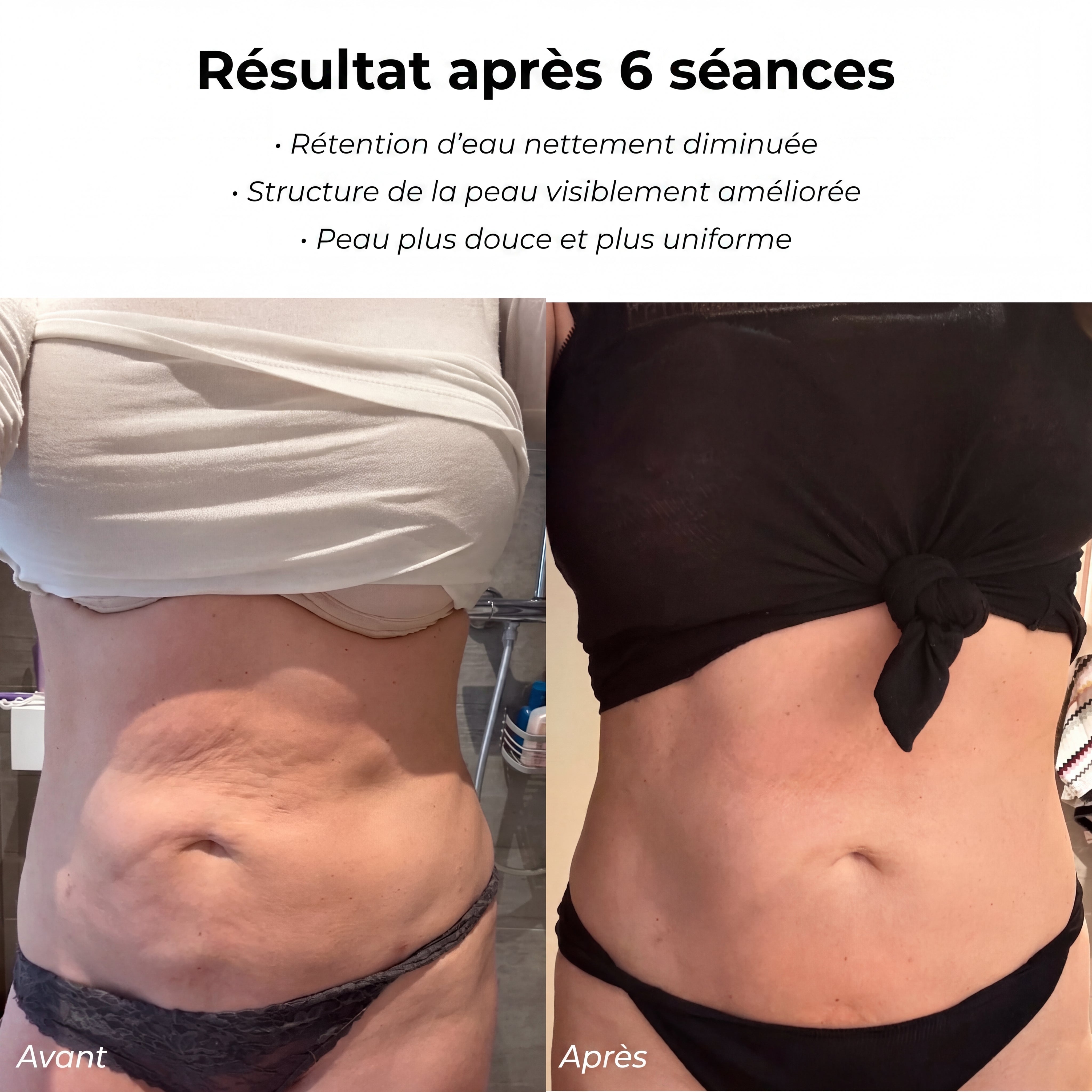 Pandore Sculpt™ | Soin anti-cellulite à domicile